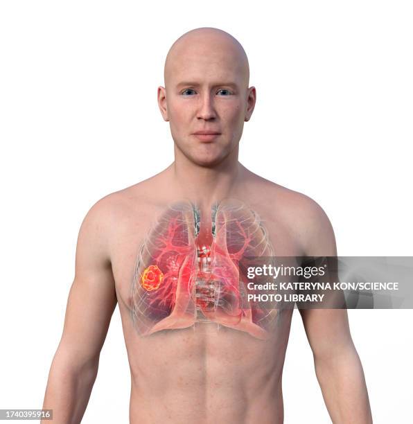 lung mucormycosis lesion, illustration - rhizopus stock illustrations