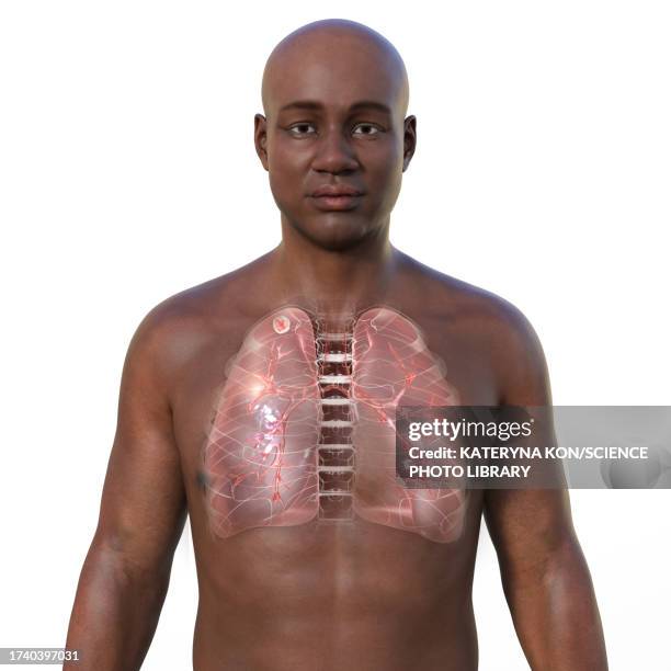 Apical System 28 Apical (Anatomy) Stock Photos, High-Res Pictures, and Images - Getty ...