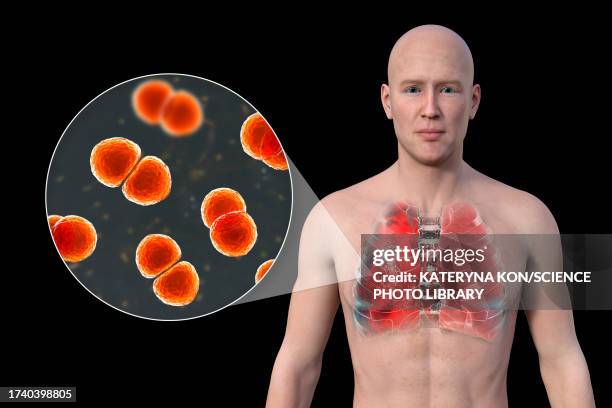 lungs affected by pneumonia, illustration - man black background stock illustrations