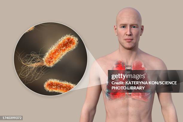 lungs affected by pneumonia, illustration - シュードモナス菌点のイラスト素材／クリップアート素材／マンガ素材／アイコン素材