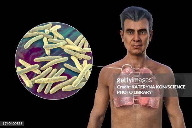 lungs affected by apical tuberculosis, illustration - man black background stock illustrations