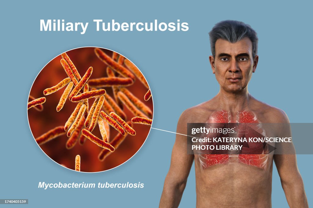 Lungs affected by miliary tuberculosis, illustration