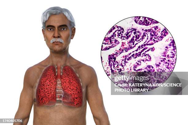 smoker's lungs, illustration - histology stock illustrations