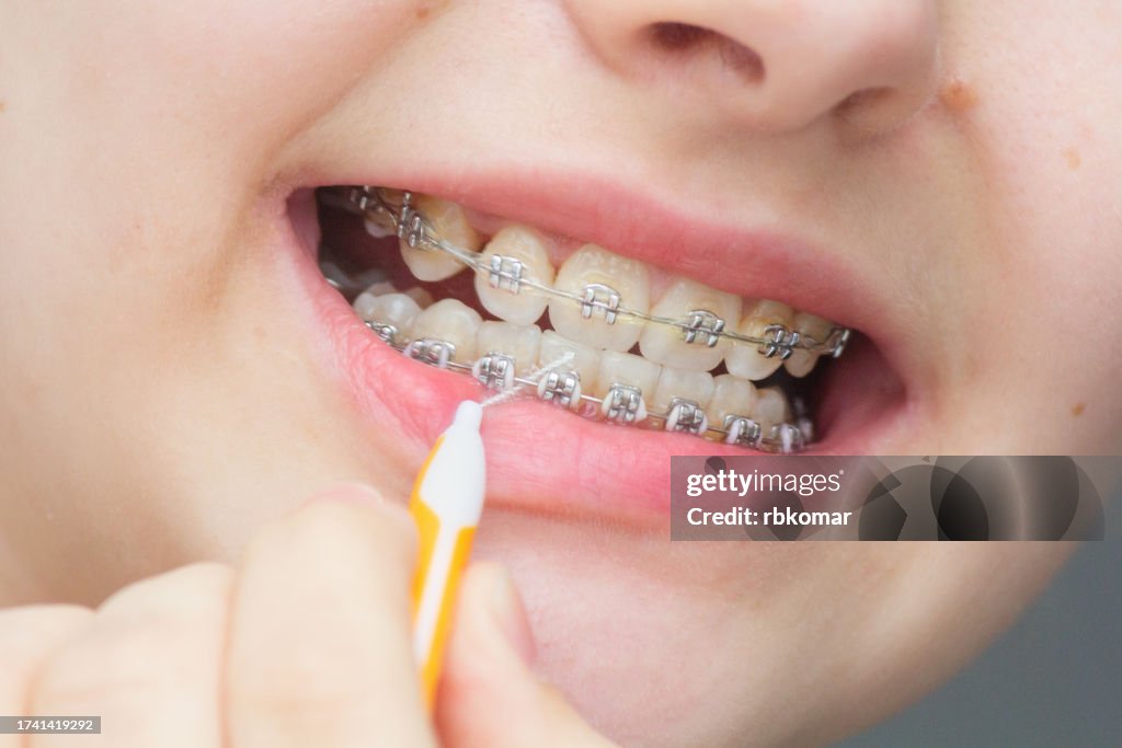 Braces care