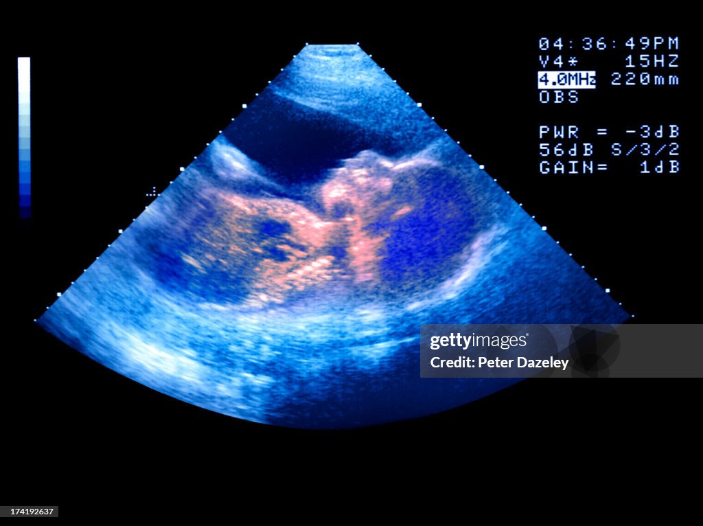 IVF baby scan
