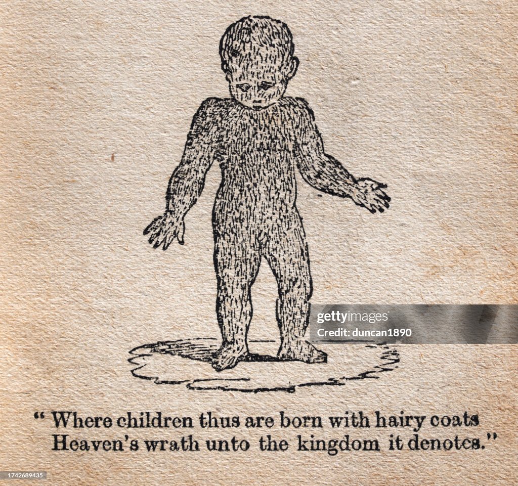 Child Born With Hypertrichosis An Abnormal Amount Of Hair Growth Over ...