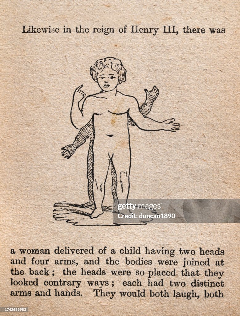 Conjoined twins, joined at the back, History of medicine, from Aristotle's Masterpiece
