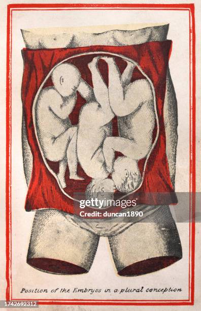 ilustraciones, imágenes clip art, dibujos animados e iconos de stock de diagrama médico victoriano, trillizos, posición del útero de los bebés, embarazo, historia de la medicina, de la obra maestra de aristóteles - fetal position