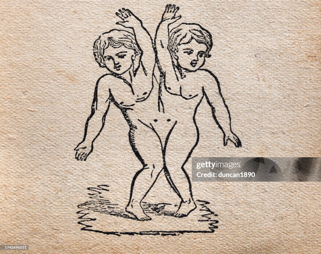 Vintage illustration Conjoined twins, joined at the side, History of medicine, from Aristotle's Masterpiece