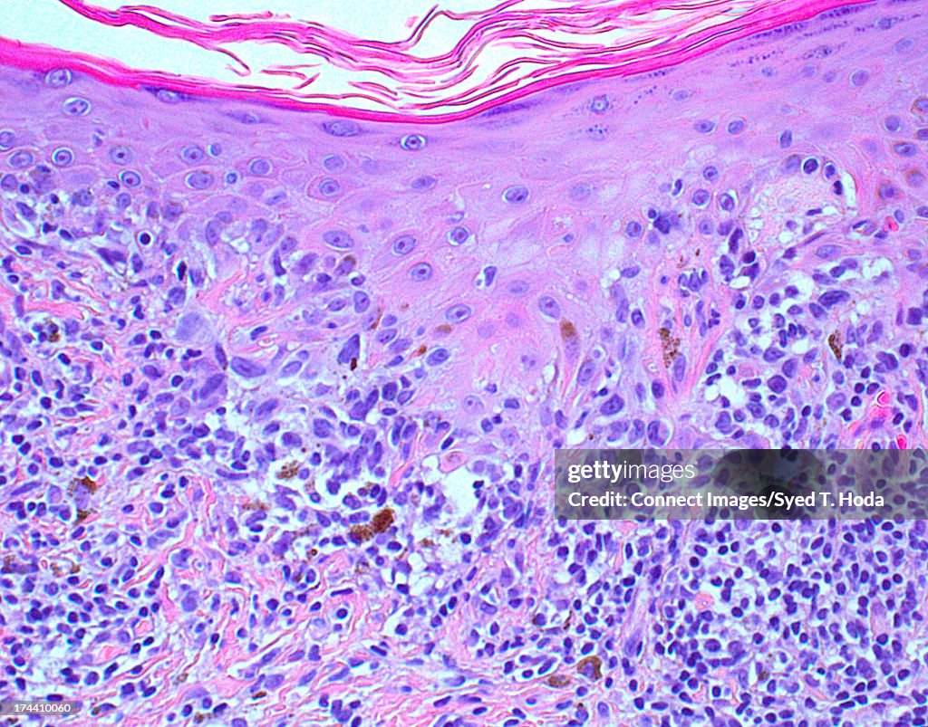Malignant Melanoma in hi-power magnification
