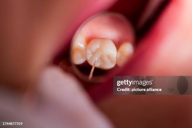 October 2023, North Rhine-Westphalia, Mönchengladbach: Dentist Dr. Kranz uses a mirror to look at a zirconium all-ceramic crown of a patient in his...