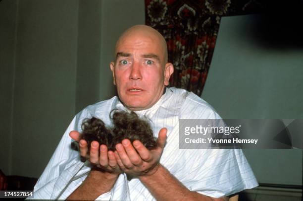 Albert Finney shows us his hair after been shaved for his role as 'Daddy' Oliver Warbucks in the movie version of "Annie" April 16, 1981 in New York...