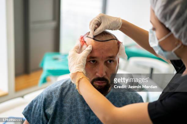 hair transplant surgery operation - haartransplantation stock-fotos und bilder