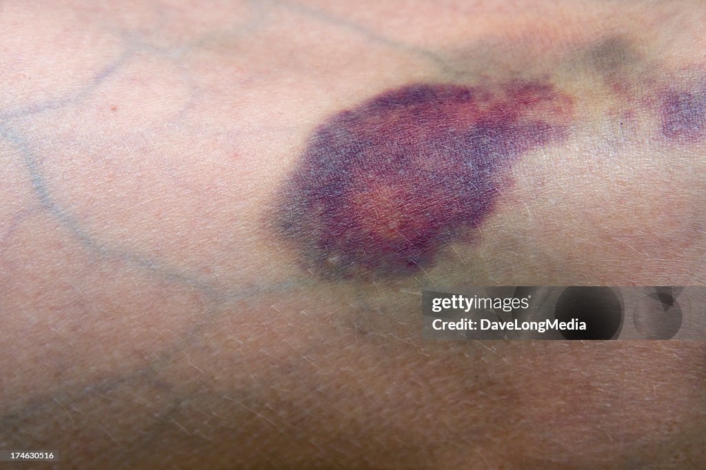 Ecchymosis Incision Ecchymose Photo - Getty Images