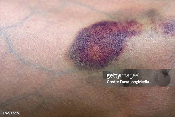 bruise - blood veins stock pictures, royalty-free photos & images