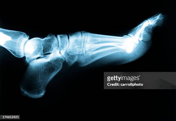 foot  & ankle x-ray - x ray body stock pictures, royalty-free photos & images