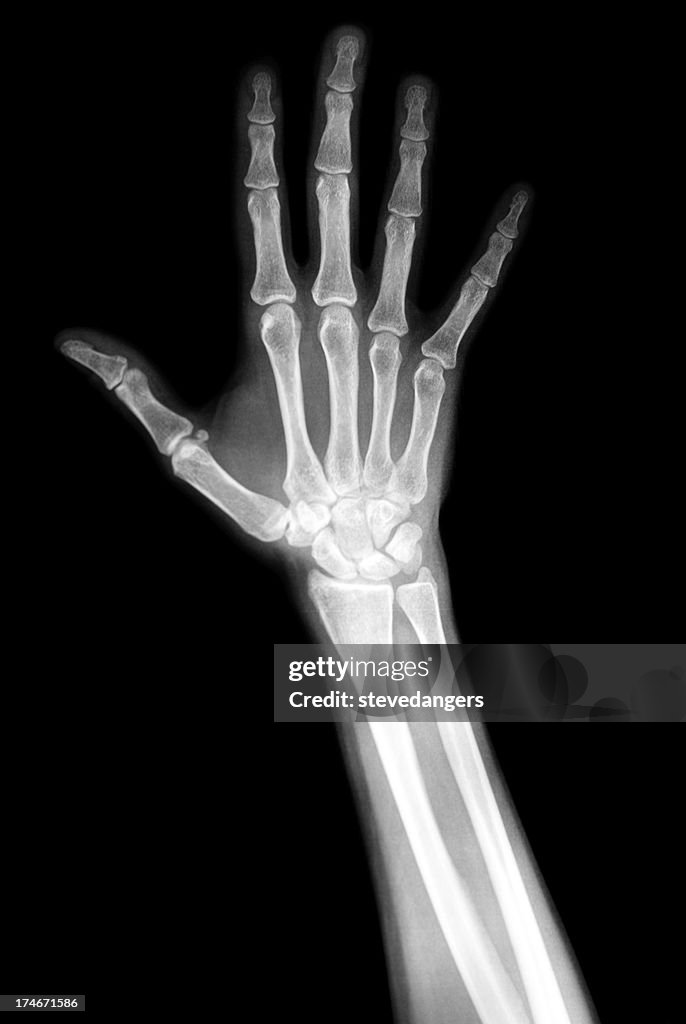 Hand Xray High-Res Stock Photo - Getty Images