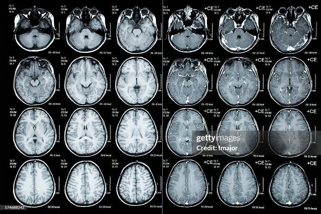 Kopf- Tomography Bild von Kind Patient