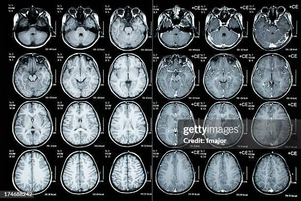 tomografía computarizada craneal imagen de paciente niño - corteza cerebral fotografías e imágenes de stock