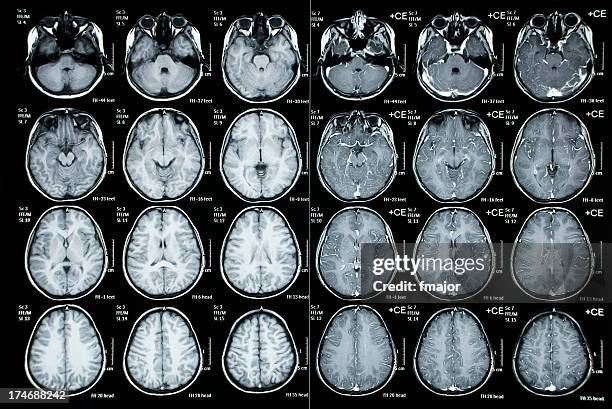 cranial tomography image of  child patient - child having medical bones stock pictures, royalty-free photos & images