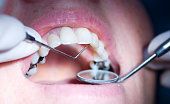 Close-up of mouth getting dental exam