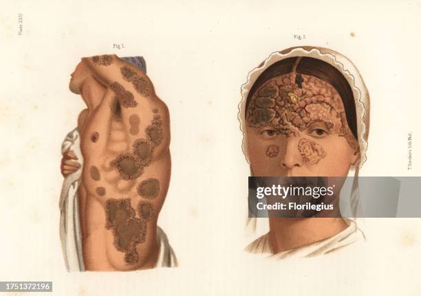 Syphilitic tubercules on the torso and arms 1, and suppurating tubercular syphilide on the face.Chromolithograph by T. Sinclaire from Freeman J....