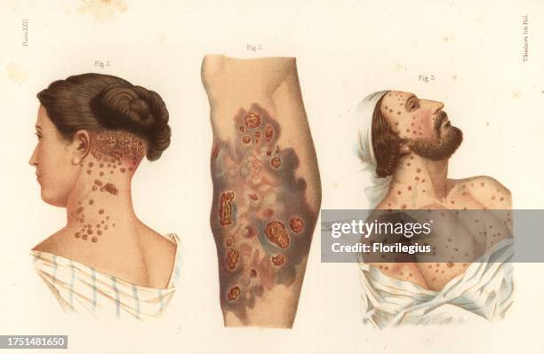 Pustular syphilide with ecthyma of the leg 1, pustular syphilide or impetigo of the neck 2, and vesicular syphilide on the face and neck 3....