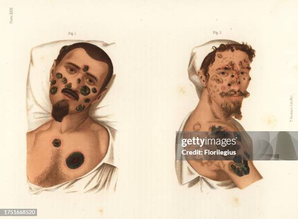 Secondary period syphilis symptoms on the body. Bullous syphilide rupia on the face treated with mercury 1, bullous syphilide rupia and cicatrices of...