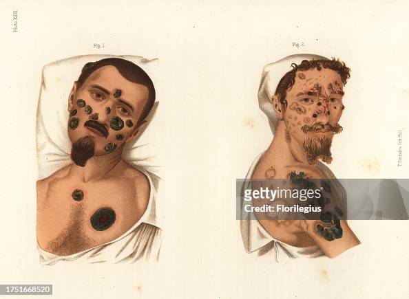 58 photos et images de Atlas Of Syphilis And The Venereal Diseases ...