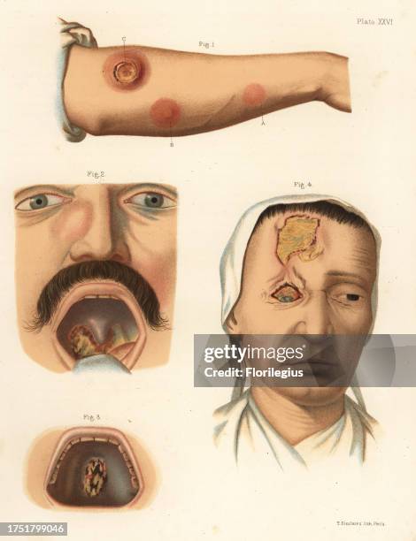 Tertiary period syphilis symptoms on the body. Gummata or gummy tumors of the forearm 1, osteitis of the bones of the nose and gummata of the tonsils...