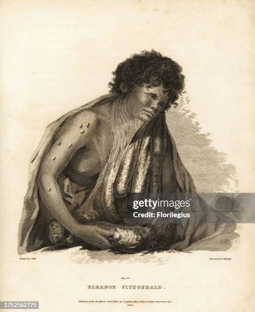 Pendulous tumours of the ear, neck, shoulder and breast. Irish beggar woman Eleanor Fitzgerald whose fibroid tumors grew back after an operation to...