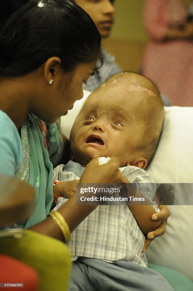 Baby Roona Begum an Indian baby who is suffering from a severe case