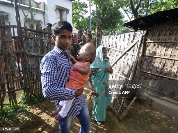 Fatima Khatun and Abdul Rahman , parents of twenty-one month old Roona Begum who underwent surgery for Hydrocephalus, in which cerebrospinal fluid...