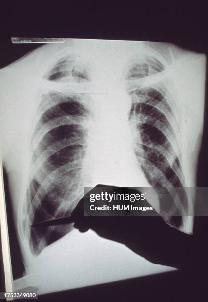 Lung damaged by emphysema is much larger than a normal lung ca. 1972.