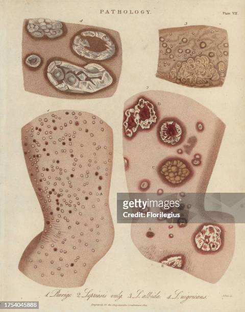 Prurigo nodularis and Psoriasis varieties. Handcoloured copperplate stipple engraving by John Pass from John Wilkes' 'Encyclopedia Londinensis,' J....