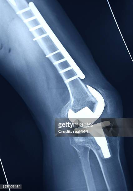 raggi x digitali seguenti successo di un intervento per la sostituzione del ginocchio - knee replacement surgery foto e immagini stock