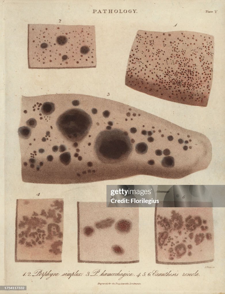 Purple spots and rose rash from John Wilkes' 'Encyclopedia Londinensis,' J. Adlard, London, 1822