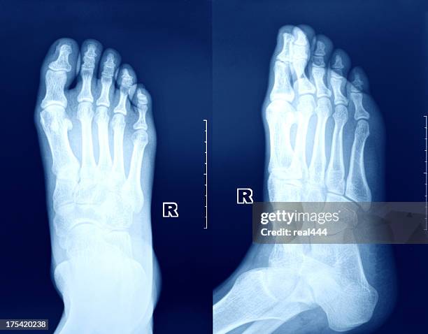 x-ray image des fußes. - broken heel stock-fotos und bilder