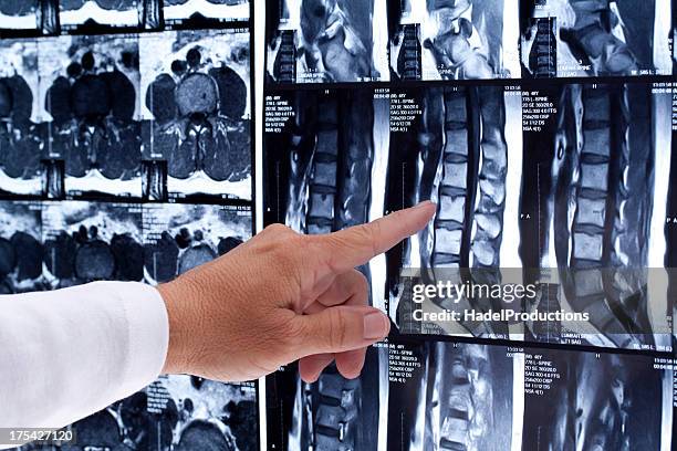 la mri de la región lumbar de la columna vertebral humana con el médico - columna vertebral fotografías e imágenes de stock