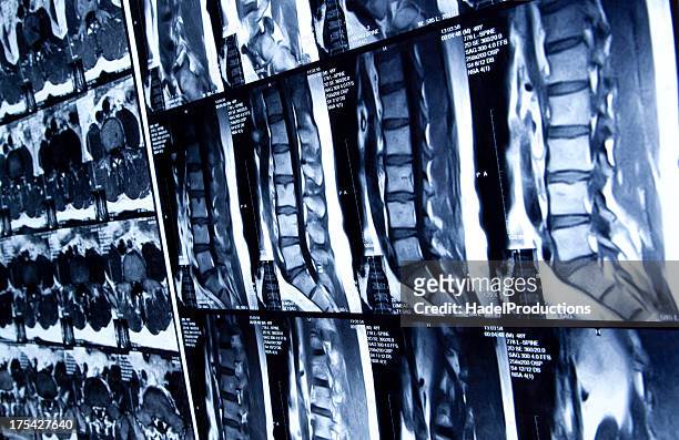 la mri de la región lumbar de la columna vertebral humana - columna vertebral humana fotografías e imágenes de stock