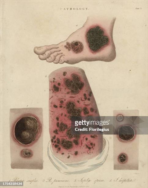 Contagious skin diseases impetigo and rhypia. Handcoloured copperplate stipple engraving by John Pass from John Wilkes' 'Encyclopedia Londinensis,'...