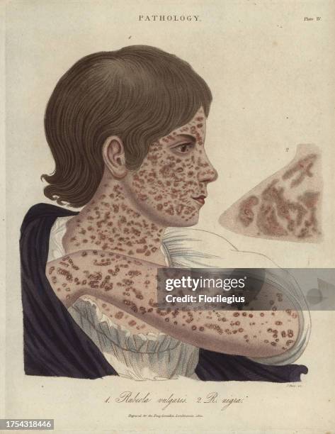 Measles, Rubeola vulgaris and R. Nigra. Handcoloured copperplate stipple engraving by John Pass from John Wilkes' 'Encyclopedia Londinensis,' J....