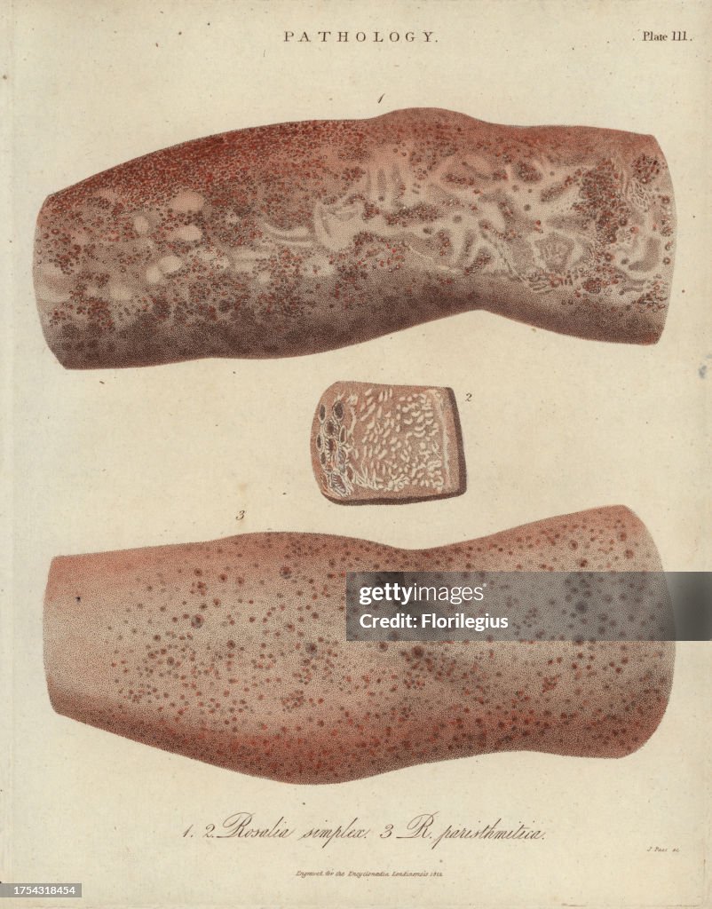 Scarlet fever from John Wilkes' 'Encyclopedia Londinensis,' J. Adlard, London, 1822