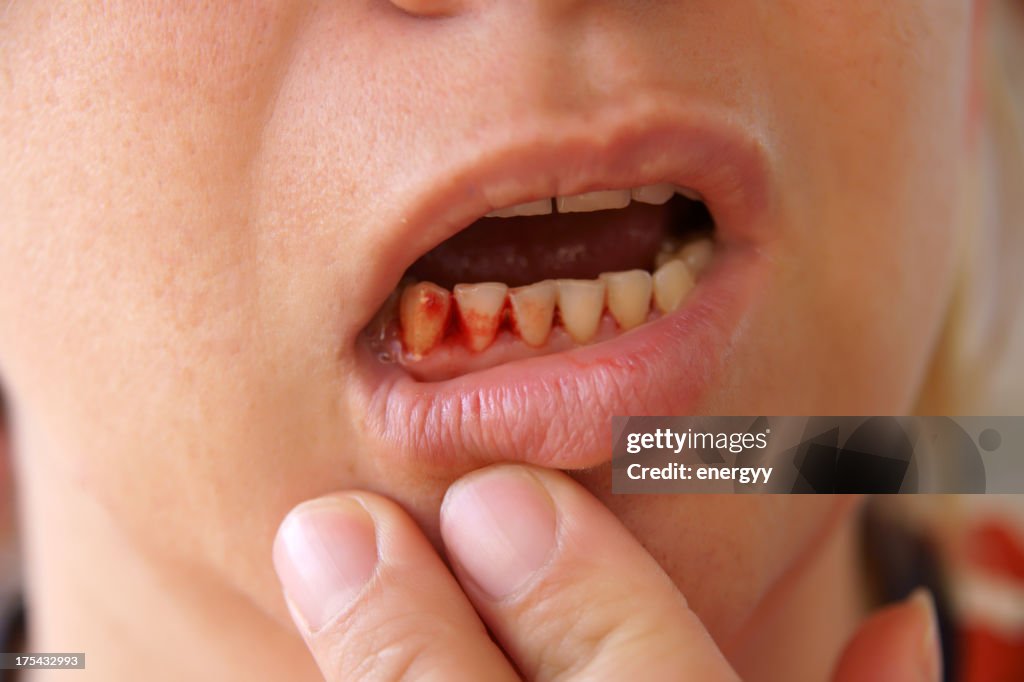 Person holding their lip down to show their bleeding gums