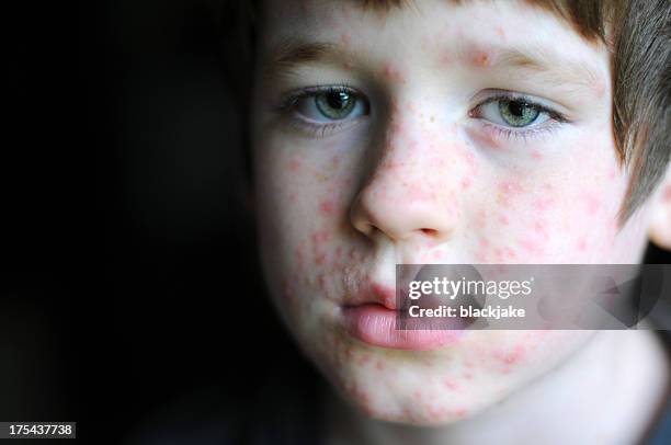 chicken pox - chickenpox stock pictures, royalty-free photos & images