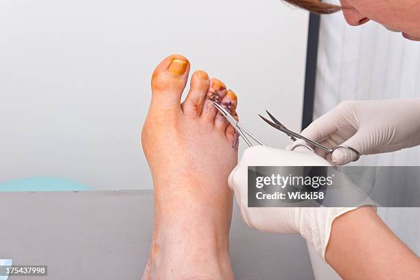 damit die fäden - schnittwunde stock-fotos und bilder