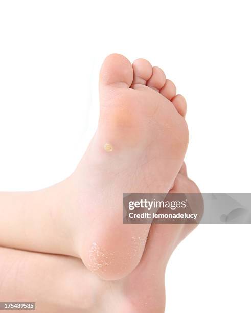 planters wart - foot wart stock pictures, royalty-free photos & images