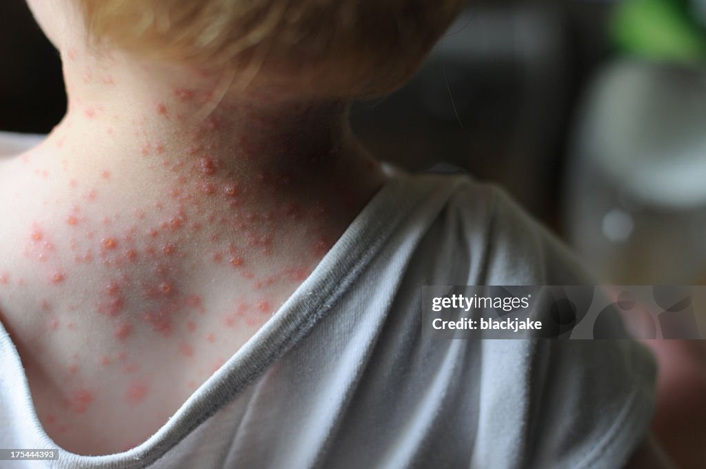 Chickenpox Rash Stock Image Chicken Pox High-Res Stock Photo - Getty Images