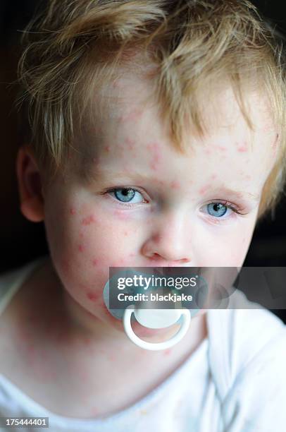 Chicken Pox High-Res Stock Photo - Getty Images