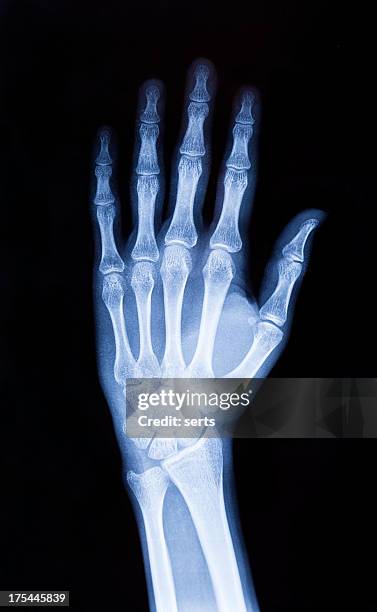 x-ray hand (xxxl) - wrist anatomy stock pictures, royalty-free photos & images